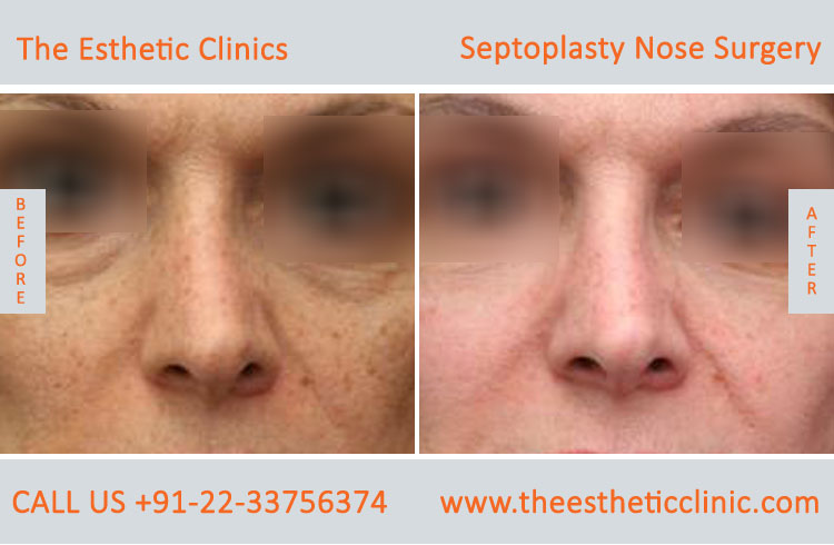 Septoplasty Nose Surgery before after photos in mumbai india (6)